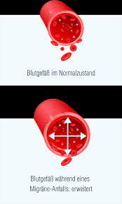 Migraneanfall Ablauf