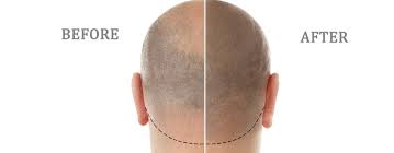 Scalp Micropigmentation How Does It Work Clinicana