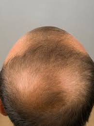 Hair loss often occurs in patients suffering or recovering from a medical condition or illness. 10 Causes Of Hair Loss Hair Loss Center Everyday Health