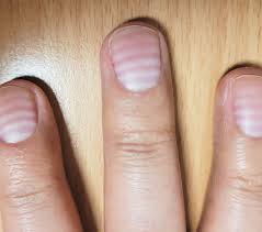 Image result for Muehrcke Line