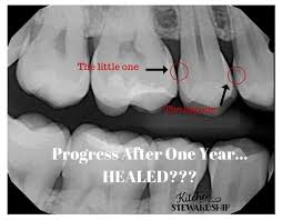 3 Experts Look At My X Rays Heal Cavities Cavities Remineralize Teeth