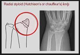 el bilegi kiriklari distal radius ulna kiriklari fizyoo elsa