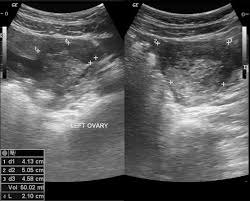 Image result for corpus luteum sonography)
