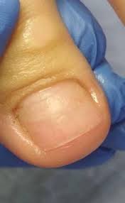 как вывести сухой мозоль со стержнем на пальце ноги Podologiya Dlya Tela Bud Zdorov Cherkassy