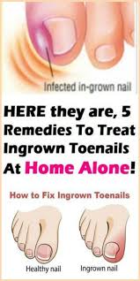 Here They Are 5 Remedies To Treat Ingrown Toenails At Home Alone Treating Ingrown Ingrown Toe Nail Ingrown Nail