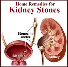Home Remedies For Kidney Stones Remedies For Kidney Infection Treat Kidney Stones Kidney Stones Symptoms