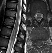 Image result for Myelitis