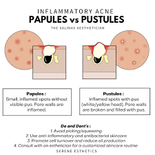 Image result for Papule