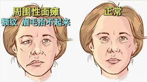 攢竹穴：眉毛最前端的眉頭。 四白穴：瞳孔下方約2指幅的凹窩。 顴髎穴：眼睛外圍往下到顴骨下緣的凹窩。 頰車穴：下頷角往內約1指幅的凹窩。 黃獻銘指出，中醫治療面癱有一個特別的針法，叫做「透針」，也就是用一根針扎2個穴位，就像是沿著皮膚把穴位串起來，能夠有效. å¥³å­éª'è½¦ä¸Šä¸‹ç­ è„¸ç«Ÿè¢«å¹æ­ªäº† 2åˆ†é'Ÿæ•™ä½ é¢„é˜²å†¬å­£é¢ç˜«