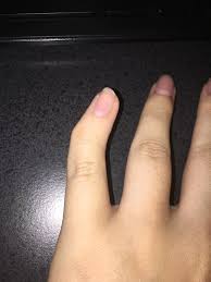 Deformity of a finger following injury should be further evaluated by a physician and in most cases it would be important to at least obtain an xray. I Was Born With Crooked Pinkies Mildlyinteresting