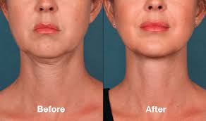 Best Neck Cream For Turkey Neck Best Neck Cream Neck Cream Firming Best Neck Firming Cream