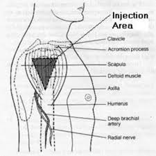 Take the cap off the vial. Deltoid Intramuscular Injection Hubpages