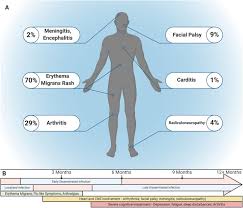 Disease is transmitted to humans and animals by ixodes ticks. Host Transcriptome Response To Borrelia Burgdorferi Sensu Lato Sciencedirect