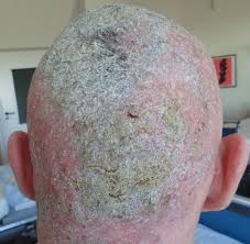 Chronic scattered and irritable follicular pustules. Appearance Of Folliculitis Decalvans On First Day Of Radiation Download Scientific Diagram
