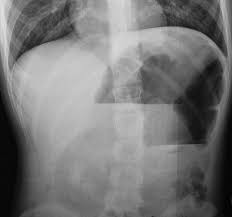 Hypermobile Eds Patient With Mobile Cecum Described In Case Study