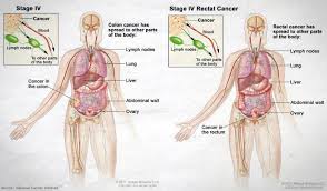 Bowel Cancer Staging Size Position Spread