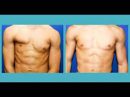 Poland Syndrome Detailed Information Photos Videos