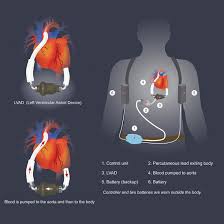 A vadis used in people who have weakened hearts or heart failure. Left Ventricular Assist Devices Lvad Heart Newyork Presbyterian