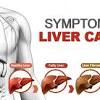 Signs and symptoms of liver cancer. 1