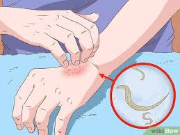 Image result for Pinworm