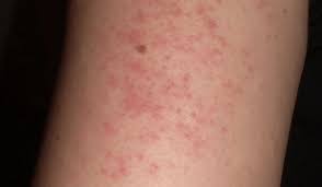 Image result for Keratosis pilaris