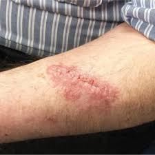 Wipe away any faeces with toilet paperthen wash the stoma and surroundingskin with warm water and dry the areathoroughly using dry wipes or kitchenroll. Postop Patient Reports Wound Infection Clinician Reviews