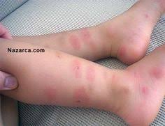 Sivrisinek Kasintisindan Nasil Kurtuluruz Nazarca Com Dogal Saglik Dogal Dis Beyazlatma Saglikli Spor Aktiviteleri