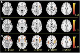 How schizophrenia affects the brain. Frontiers A New Division Of Schizophrenia Revealed Expanded Bilateral Brain Structural Abnormalities Of The Association Cortices Psychiatry