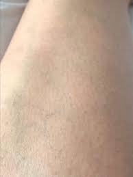 While it's undeniably expensive, you get value for your money. Does Ipl At Home Work Philips Lumea Review Indiana Jo