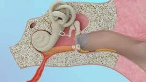 Clogged Ear Due To Ear Infection Or Eustachian Tube Dysfunction - Youtube