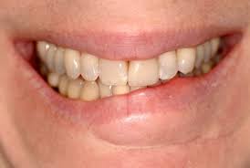 Think about correction at an early age when the child begins the change in primary dentition to ► how to have a beautiful smile if teeth are crooked? Lip Service How To Evaluate A Crooked Smile Spear Education