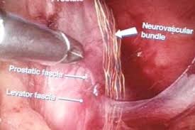 Image result for Radical Prostatectomy