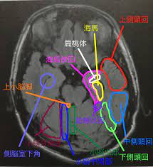 脳画像 側脳室下角レベル 全体図 医学 筋肉解剖学 解剖学
