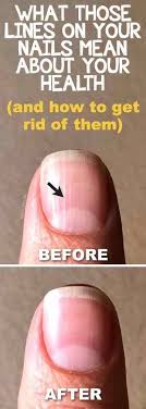 What Those Lines On Your Nails Mean About Your In 2020 Health Beauty Health Health Tips