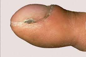 Image result for Clubbing nails feet