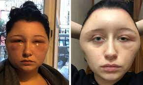 No matter what product you are about to use it is always a good idea to perform the test 24 to 48 hours before to prevent potential. I Almost Died Young French Woman Disfigured By Hair Dye The Local