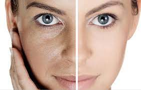 Enlarged Pores