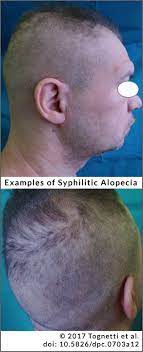 Hair loss does not occur in the primary stage of the disease. This Common Std Can Cause Hair Loss For Men And Women
