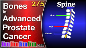 Jaundice or swelling in the belly, when cancer has spread to the liver. Metastatic Prostate Cancer In The Spine Bones Youtube