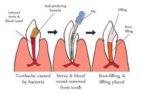 An Area Of Soft Tissue Below The Outer Enamel Of Tooth And Within The Dentin Contains Nerve Fibers Which Are Com Root Canal Treatment Root Canal Dental Clinic