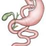 gastric bypass surgery from weightlosssurgery.wustl.edu