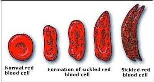 Sickle Cell Disease What We Should Know Chicago Defender