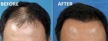 We have designed a specialized treatment that employs patient's own prp. Stem Cell Hair Transplantation Stem Cell Hair Treatment In Bangalore
