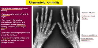 Image result for XRay Changes in Rheumatic Conditions
