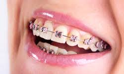 Start by removing loose food particles. Five Tips For Cleaning Braces In Queens Ny