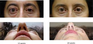 Teprotumumab for thyroid eye disease: early response is not required for  benefit