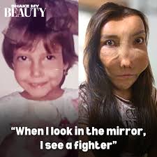 Leidy lives with fibrous dysplasia, an uncommon bone disorder where  scar-like tissue develops in place of normal bone. The condition developed  after Leidy had heart surgery as a baby, where the amount