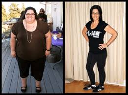 Pin On Weight Reduction Surgeries