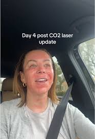 Co2re Fractional Laser Day 4