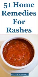 51 Home Remedies For Treating Rashes On Face And Body In 2020 Treat Rash Rashes Remedies Home Remedies For Rashes